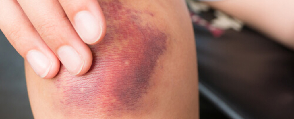 Internal bleeding is included in severe cases